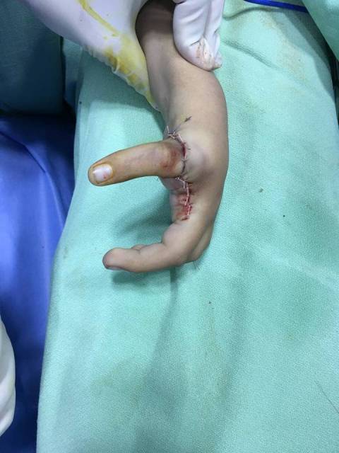 عملية زراعة نوعية لاصابع طفل بمستشفى المقاصد